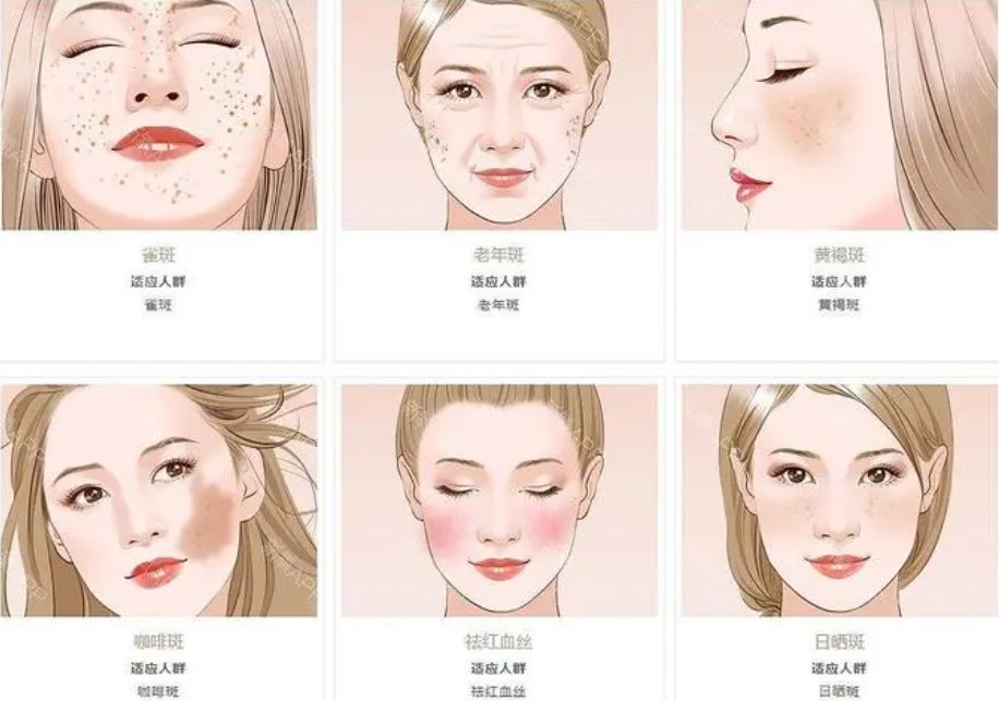 濾光片 激光美容適宜人群